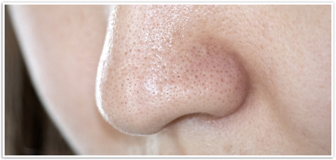 肌トラブルケア